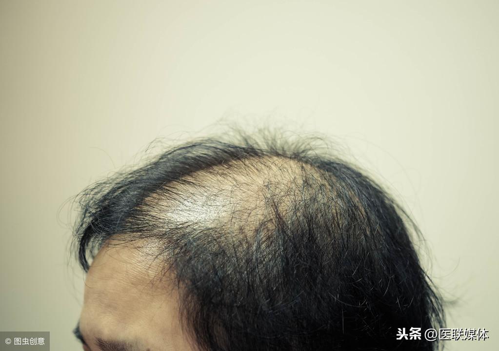 脂溢性脱发是不是没救了_脱发不是脂溢性脱发_脂溢性脱发不油怎么还脱发